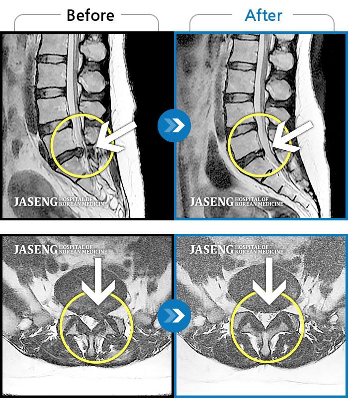 일산자생한방병원 치료사례 MRI로 보는 치료결과-허리와 좌측 하지 방사통이 심하시어 보행이 거의 힘들었다.