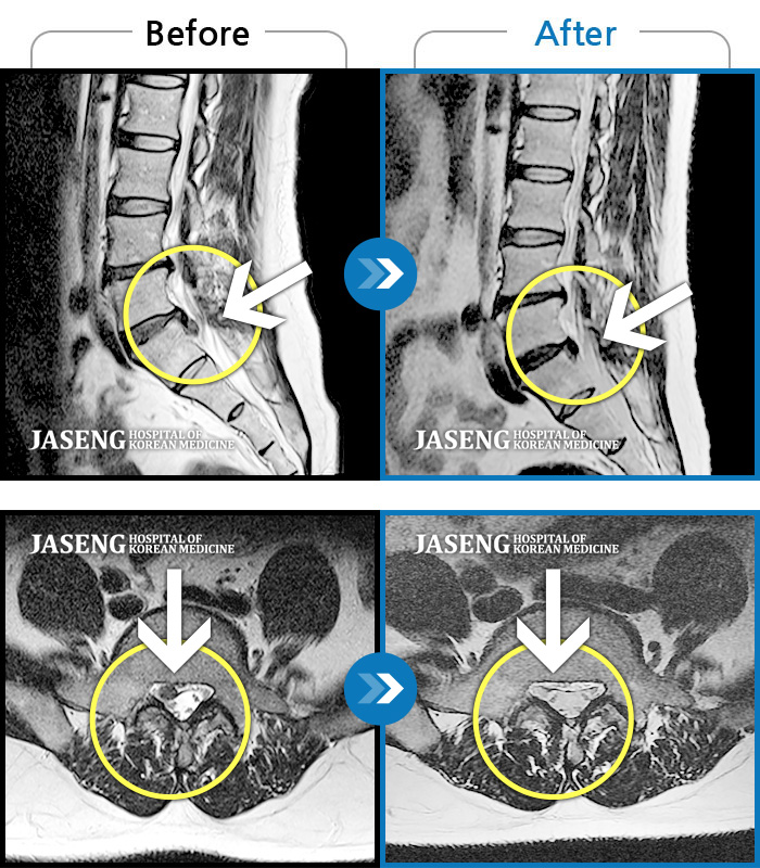 일산자생한방병원 치료사례 MRI로 보는 치료결과-오른쪽 허리, 엉덩이 통증이 극심했고, 오른쪽 엄지발가락이 먹먹한 동시에 힘이 빠졌다.