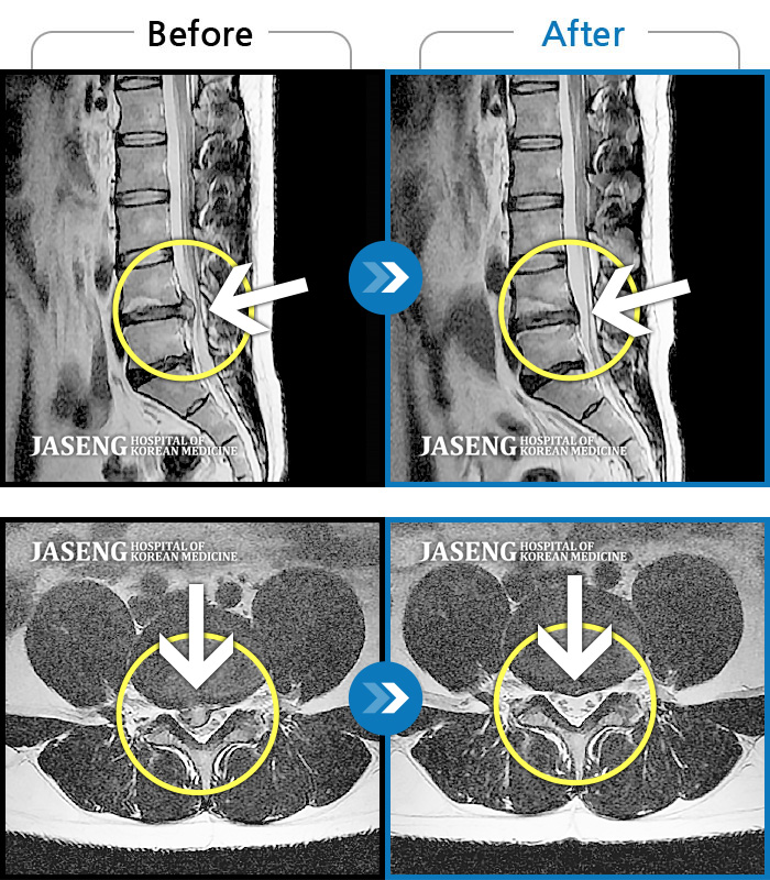 일산자생한방병원 치료사례 MRI로 보는 치료결과-허리 골반통증이 극심했다.