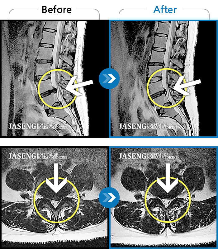 일산자생한방병원 치료사례 MRI로 보는 치료결과-처음 내원 시 허리 및 좌측 골반부, 하지부 통증 및 저림이 심해서 거동이 힘든 상태였습니다.
