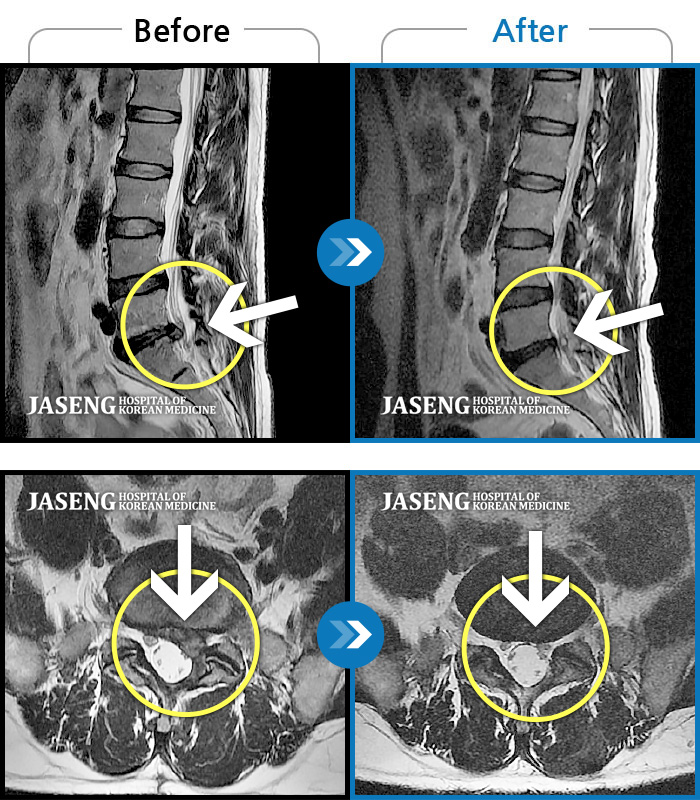 일산자생한방병원 치료사례 MRI로 보는 치료결과-허리, 좌측 골반, 좌측 다리 통증 및 저림이 심해서 정상적인 일상생활이 힘든 상태