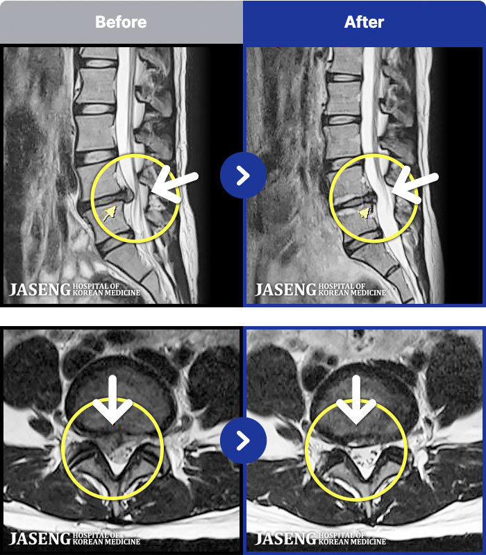 �����ڻ��ѹ溴�� ġ���� MRI�� ���� ġ����-�� 1�� ���� ���� �ʴ� ���� �㸮���� ���, ������������ �̾����� ���� �� �ɾҴ� �Ͼ �� ���� ��ȭ�Ǿ� �����ϼ̽��ϴ�.