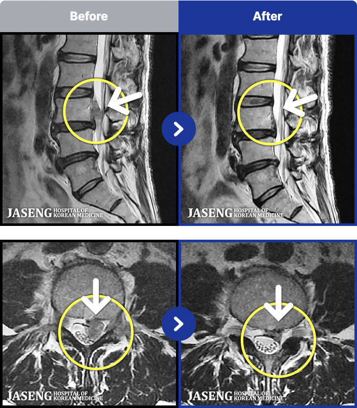 ��õ�ڻ��ѹ溴�� ġ���� MRI�� ���� ġ����-���� �㸮, ��� �ĸ� ������ ������ ������ ���� ����