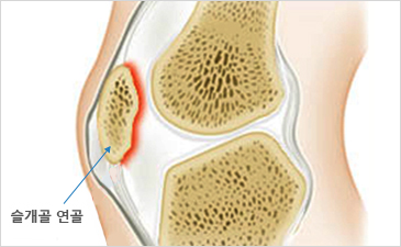 일산자생한방병원 무릎질환 슬개골연골연화증-슬개골 연골이 위치해 있는 무릎 설명 이미지