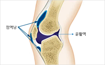 일산자생한방병원 무릎질환 무릎점액낭염-점액낭과 윤활액이 위치해 있는 무릎 설명 이미지