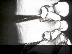 일산자생한방병원 허리질환 퇴행성디스크-정상척추에 관련된 이미지 입니다.