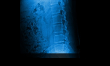 일산자생한방병원 허리질환 척추후만증-척추후만증에 관련된 이미지 입니다.