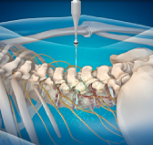일산자생한방병원 허리치료법 신경근회복술-신경근회복술의 특징 두번째 관련 사진 입니다.